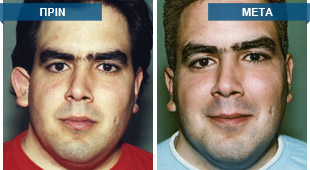 Εναρμόνιση θέσης δεξιού πτερυγίου, σύμφωνα με το φυσιολογικό αριστερό πτερύγιο. Εμφανής η δημιουργία ανθέλικας στο δεξί πτερύγιο.