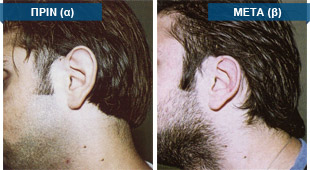 Περιστατικό: Διόρθωση αφεστώτων ώτων (πεταχτών αυτιών), με ταυτόχρονη ελάττωση του μεγέθους των πτερυγίων