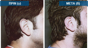 Περιστατικό: Διόρθωση αφεστώτων ώτων (πεταχτών αυτιών), με ταυτόχρονη ελάττωση του μεγέθους των πτερυγίων