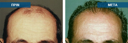 Μεταμόσχευση μαλλιών πριν -
μετά