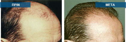 Μεταμόσχευση μαλλιών πριν -
μετά