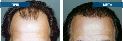 Μεταμόσχευση μαλλιών πριν -
μετά