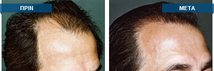 Μεταμόσχευση μαλλιών πριν -
μετά