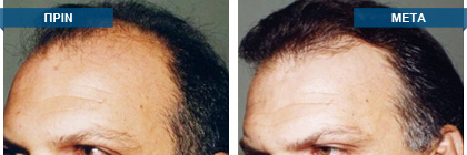 Μεταμόσχευση μαλλιών πριν -
μετά