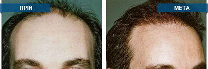 Μεταμόσχευση μαλλιών πριν -
μετά