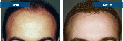 Μεταμόσχευση μαλλιών πριν -
μετά