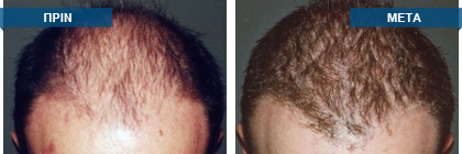 Μεταμόσχευση μαλλιών πριν -
μετά