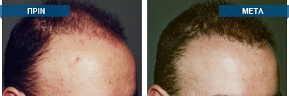 Μεταμόσχευση μαλλιών πριν -
μετά