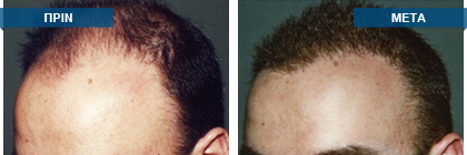 Μεταμόσχευση μαλλιών πριν -
μετά