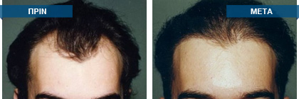 Μεταμόσχευση μαλλιών πριν -
μετά