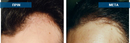 Μεταμόσχευση μαλλιών πριν -
μετά