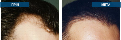 Μεταμόσχευση μαλλιών πριν -
μετά