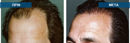 Μεταμόσχευση μαλλιών πριν -
μετά