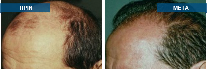 Μεταμόσχευση μαλλιών πριν -
μετά