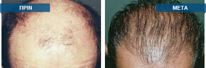 Μεταμόσχευση μαλλιών πριν -
μετά