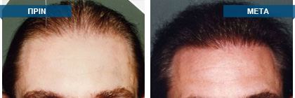 Μεταμόσχευση μαλλιών πριν -
μετά