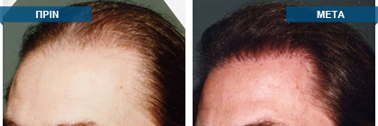 Μεταμόσχευση μαλλιών πριν -
μετά