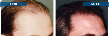 Μεταμόσχευση μαλλιών πριν -
μετά