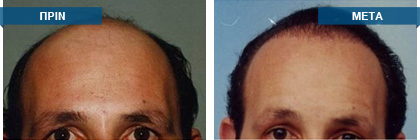 Μεταμόσχευση μαλλιών πριν -
μετά