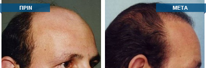 Μεταμόσχευση μαλλιών πριν -
μετά