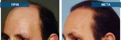 Μεταμόσχευση μαλλιών πριν -
μετά