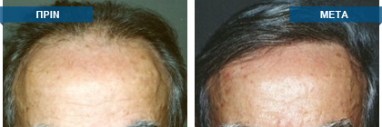 Μεταμόσχευση μαλλιών πριν -
μετά