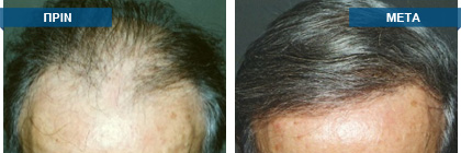 Μεταμόσχευση μαλλιών πριν -
μετά