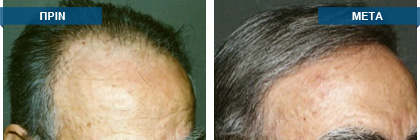 Μεταμόσχευση μαλλιών πριν -
μετά