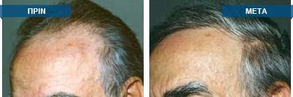 Μεταμόσχευση μαλλιών πριν -
μετά