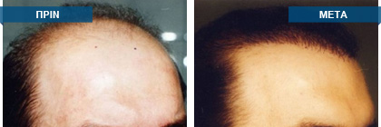 Μεταμόσχευση μαλλιών πριν -
μετά