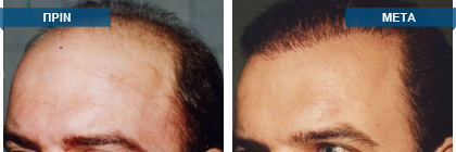 Μεταμόσχευση μαλλιών πριν -
μετά