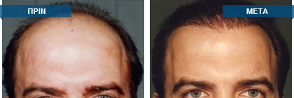 Μεταμόσχευση μαλλιών πριν -
μετά