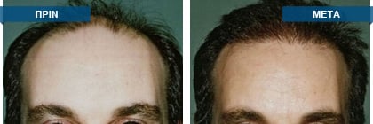 Μεταμόσχευση μαλλιών πριν -
μετά