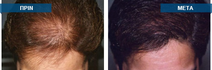 Μεταμόσχευση μαλλιών πριν -
μετά