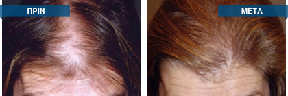 Μεταμόσχευση μαλλιών πριν -
μετά