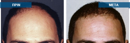 Μεταμόσχευση μαλλιών πριν -
μετά