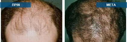 Μεταμόσχευση μαλλιών πριν -
μετά