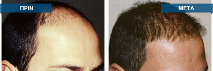 Μεταμόσχευση μαλλιών πριν -
μετά