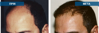 Μεταμόσχευση μαλλιών πριν -
μετά