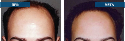 Μεταμόσχευση μαλλιών πριν -
μετά