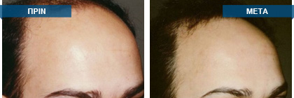 Μεταμόσχευση μαλλιών πριν -
μετά