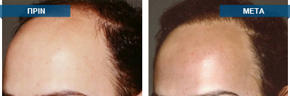 Μεταμόσχευση μαλλιών πριν -
μετά