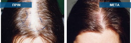 Μεταμόσχευση μαλλιών πριν -
μετά