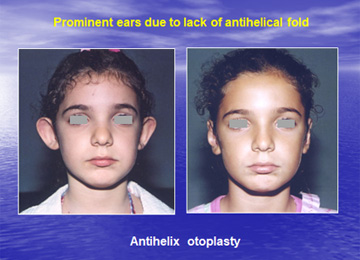 Διόρθωση πεταχτών αυτιών με δημιουργία ανθέλικας