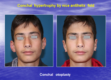 Διόρθωση πεταχτών αυτιών με ελάττωση της υπερτροφικής κόγχης