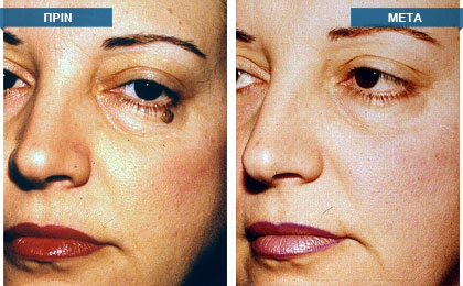 Αφαίρεση μικρού σπίλου