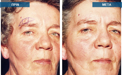 Σχεδιασμός και αφαίρεση ελιάς μετώπου. Πλαστική αποκατάσταση του ελλείμματος με διπλό νησιδιακό κρημνό. Η ιστολογική εξέταση παρουσίασε εικόνα βασικοκυτταρικού καρκινώματος.