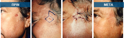 Σχεδιασμός και αφαίρεση σπίλου. Στη συνέχεια πλαστική αποκατάσταση του ελλείμματος με γειτονικό δερματικό κρημνό, τύπου Limberg