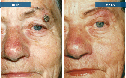 Αφαίρεση ελιάς άνω βλεφάρου και πλαστική αποκατάσταση με απλή συρραφή