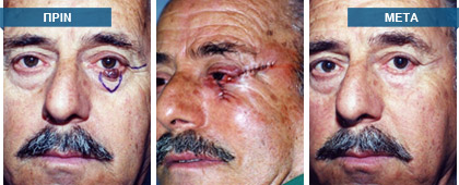 Σχεδιασμός και αφαίρεση δερματικής βλάβης κάτω βλεφάρου. Πλαστική αποκατάσταση του ελλείμματος με μεταθετικό γειτονικό κρημνό. Η ιστολογική εξέταση έδειξε εικόνα βασικοκυτταρικού καρκινώματος.